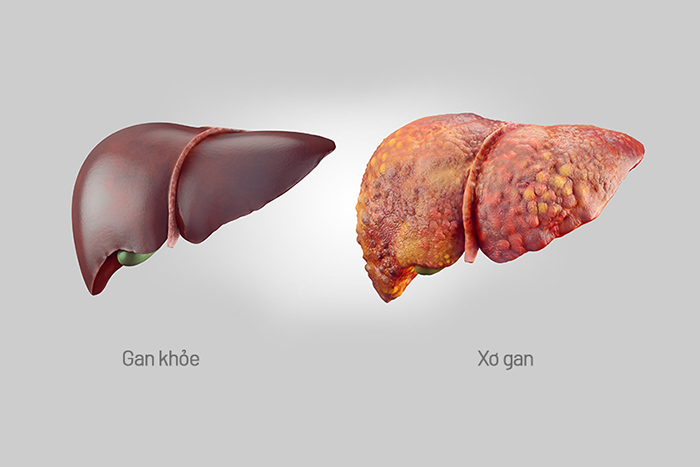 Bệnh lý gan xơ cứng