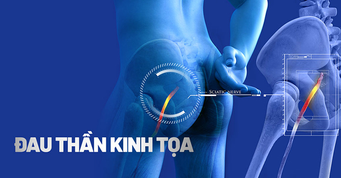 đau dây thần kinh tọa