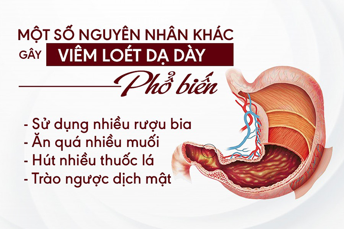 Nguyên nhân dẫn đến bệnh dạ dày