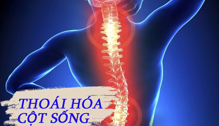 thoái hóa cột sống