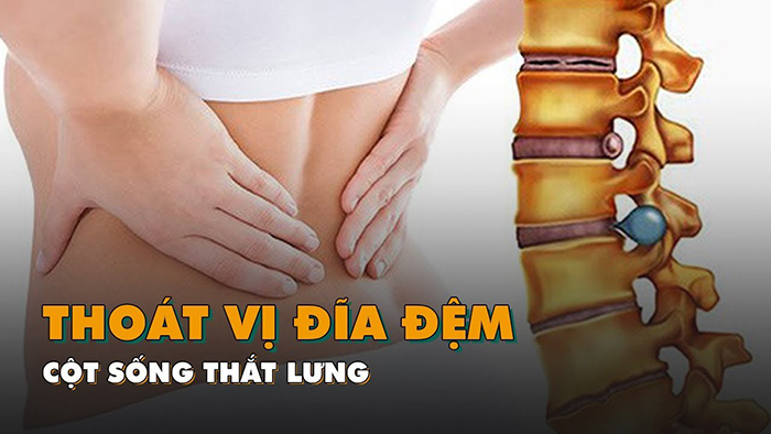 thoát vị đĩa đệm