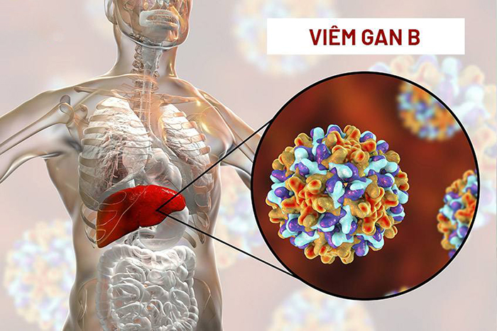 Bệnh viêm gan siêu vi B