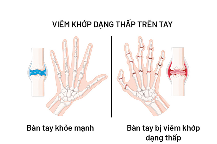 viêm xương khớp dạng thấp