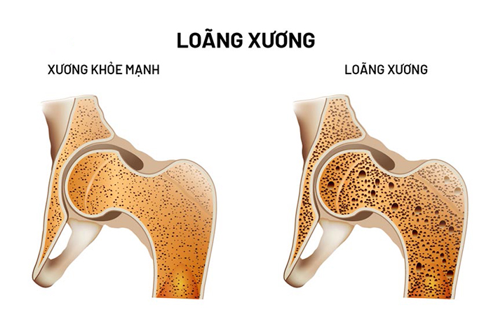 bệnh lý loãng xương