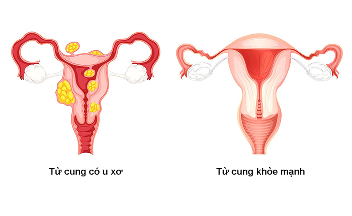 u xơ tử cung là gì?