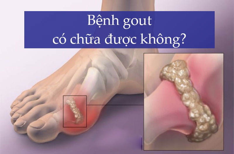 bệnh gout