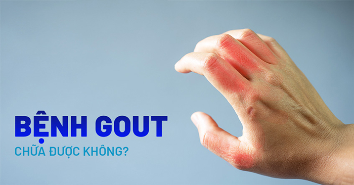 Bệnh gout có thể chữa khỏi không?